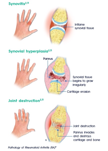 Rheumatoid Arthritis Articles Dis Chem